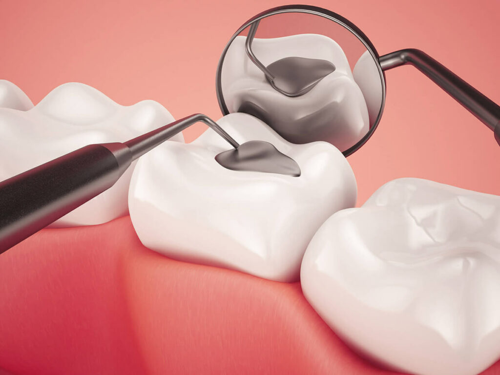 Tooth Fillings  Swfamilydentistry